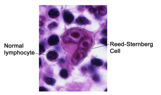 Reed-Sternberg Cell